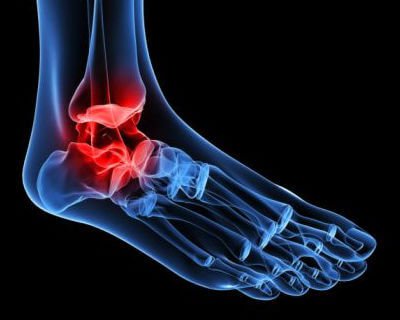 Figura de artrose de tornozelo
