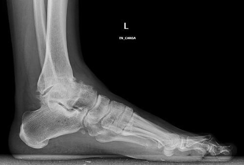 Imagem da artrose de tornozelo