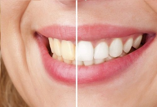 Dentes brancos e amarelados
