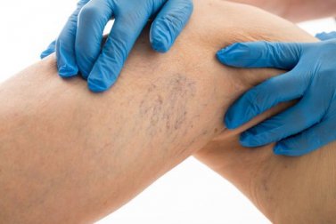 Dores causadas pelas varizes: como aliviá-las