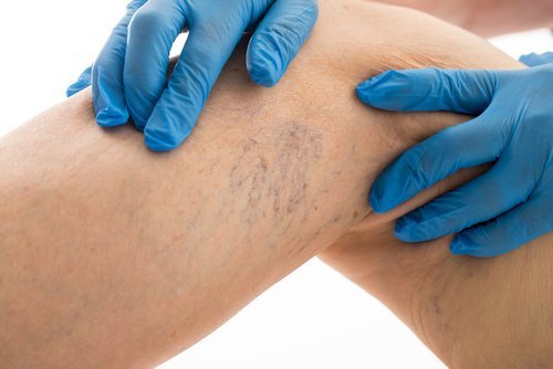 Dores causadas pelas varizes: como aliviá-las