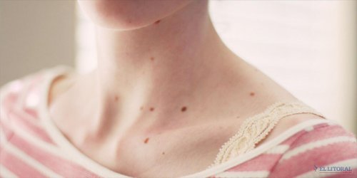 Lesões na pele que podem ser sintomas de câncer