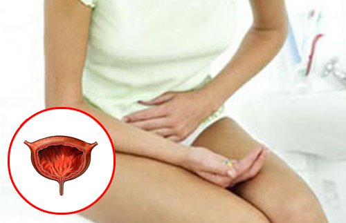 Moça com dor na area genital por causa de fibroma uterino