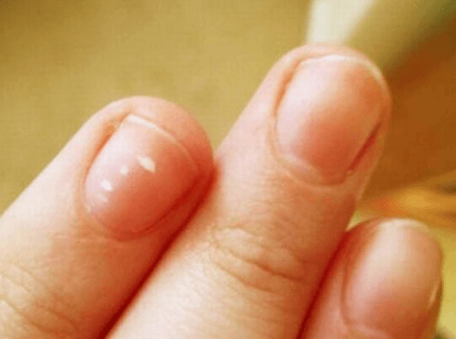 Aparecimento de manchas brancas nas unhas