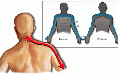 Homem com cervicobraquialgia