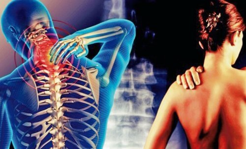 Cervicobraquialgia: dor que vai do pescoço ao braço