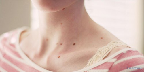 Ervas que podem reduzir o risco de câncer de pele