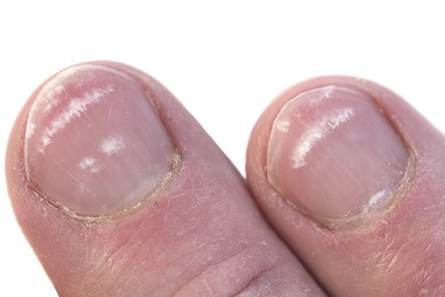 Por que aparecem manchas brancas nas unhas?