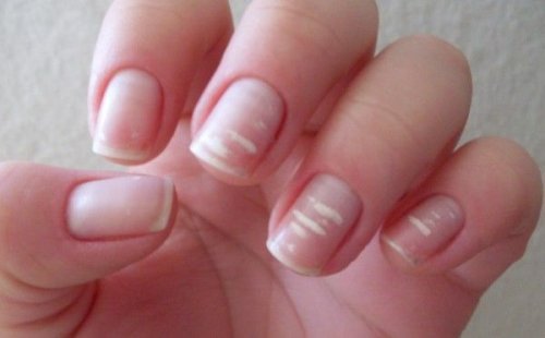 Manchas brancas nas unhas