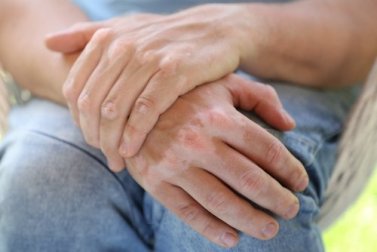É possível curar o vitiligo com remédios caseiros?