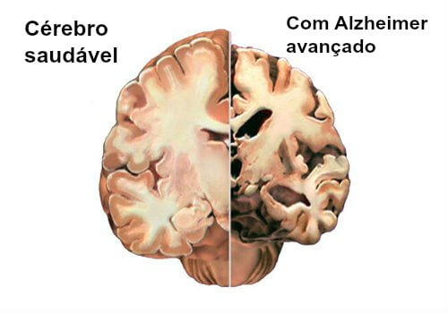 alzheimer