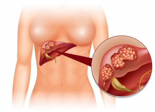 Imagem ressaltando o fígado de uma mulher e o nível alto de estrogênio