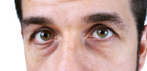 4 soluções naturais para acabar com as olheiras