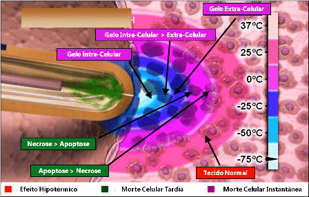 crioablacao_infografico