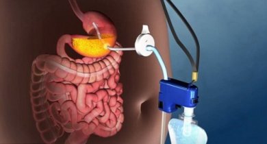Descubra esta nova técnica para tratar a obesidade grave sem cirurgia