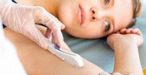 implante_anticoncepcional_subdermico