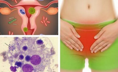 Dicas para aliviar uma infecção vaginal por fungos