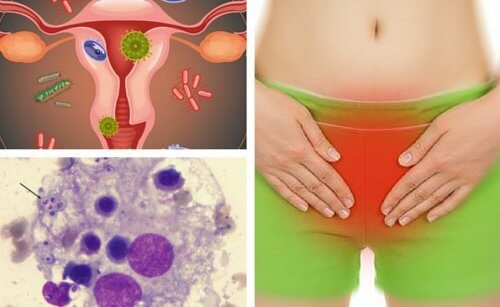 Dicas para aliviar uma infecção vaginal por fungos