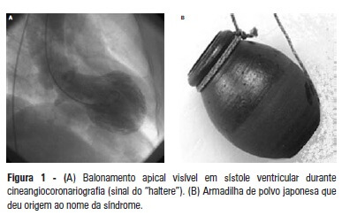 sindrome_coracao_partido