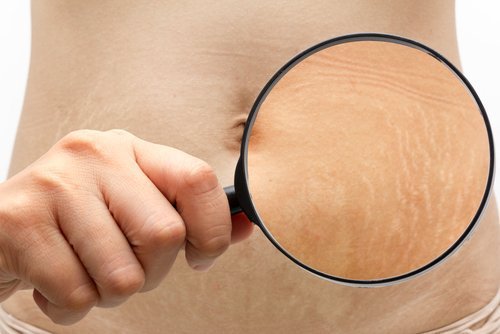 6 truques para melhorar a aparência das estrias