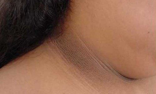 4 maneiras de clarear áreas escuras no pescoço