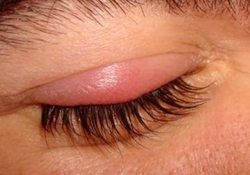 8 remédios eficazes para tratar o terçol