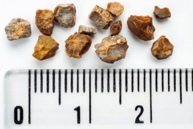 Pedras nos rins: 6 receitas caseiras para combatê-las