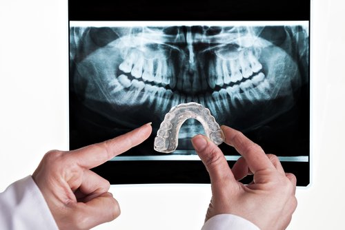 Placa dental para bruxismo