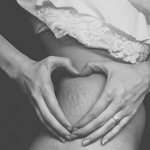 mulher_coracao_estrias