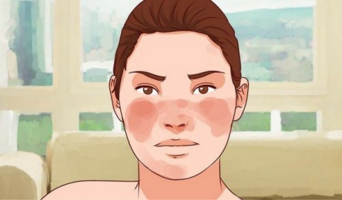 7 remédios para controlar o lúpus 7 remédios para controlar o lúpus
