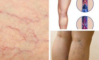 5 mudanças para ter saúde vascular nas pernas