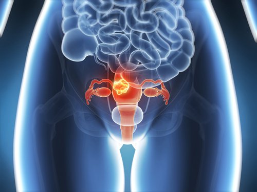 6 sintomas de câncer no colo uterino que é preciso conhecer 6 sintomas de câncer no colo uterino que é preciso conhecer
