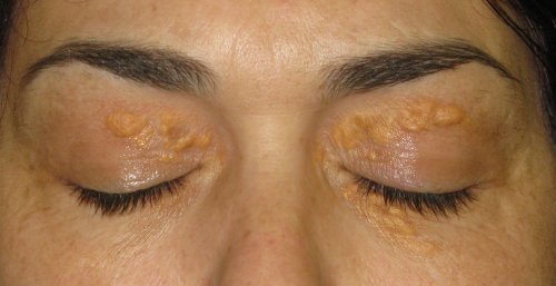 Xantelasma: as manchas brancas ao redor dos olhos