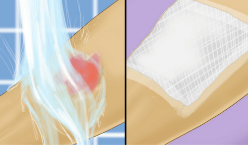 Primeiros auxílios para queimaduras com água quente