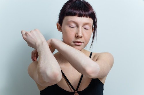Tratamentos para o vitiligo