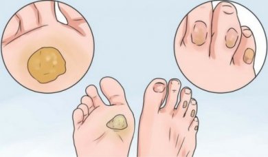 10 remédios para dizer adeus aos calos e bolhas