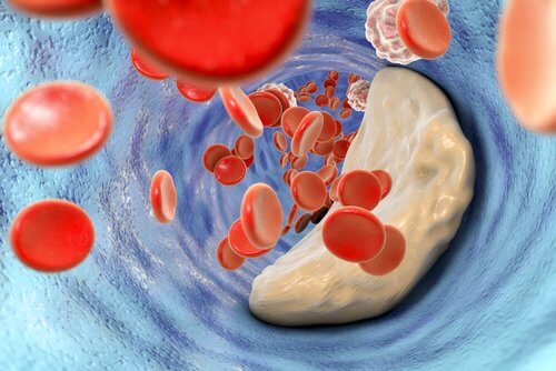 O que se deve saber sobre o acidente vascular cerebral?