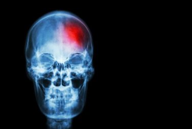 Possíveis sinais que alertam sobre um acidente vascular cerebral
