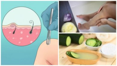 5 soluções naturais para eliminar os pelos encravados