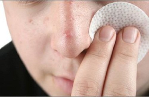 Água oxigenada contra a acne