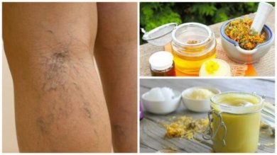 Como preparar uma pomada de arnica para atenuar as varizes e microvarizes
