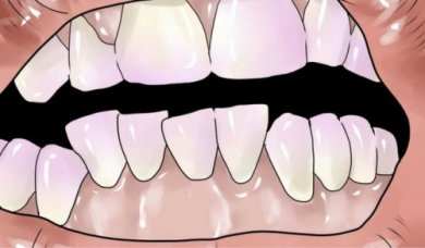 Como eliminar o tártaro dos dentes naturalmente