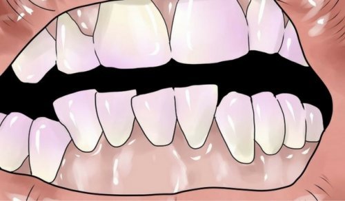 Como eliminar o tártaro dos dentes naturalmente