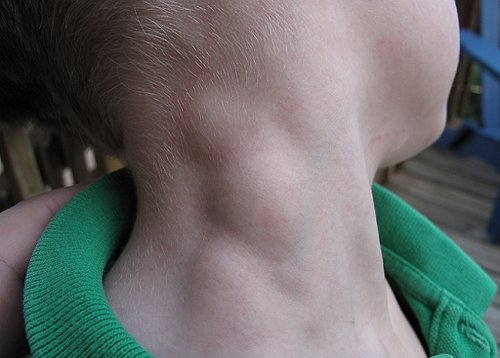 linfoma