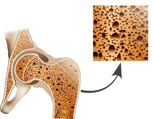 Osteoporose