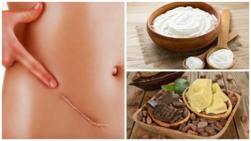 Os 7 melhores remédios para atenuar cicatrizes de forma natural