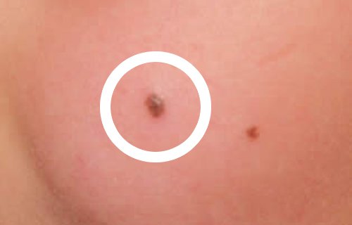 Câncer de pele do tipo melanoma