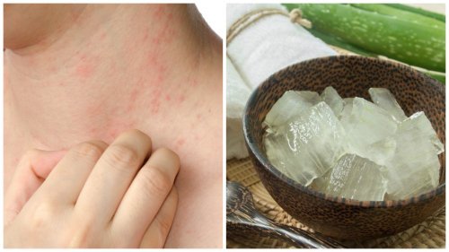 Alergia causada pelo calor: 7 soluções eficazes