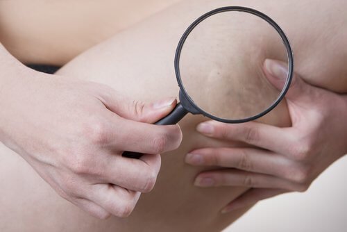 Celulite por causa do uso de roupas muito apertadas