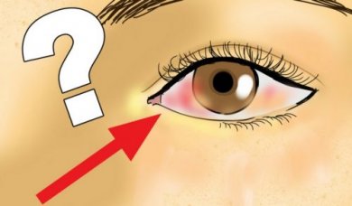 Descolamento de retina: o que é, causas e prevenção